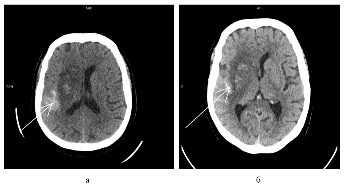 МСКТ головного мозга без контрастного усиления в аксиальной проекции пациентки Н. после выполнения ТЭ:а - первые сутки после лечения; б - четвертые сутки после лечения