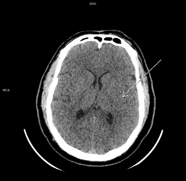 МСКТ головного мозга без контрастного усиления в аксиальной проекции пациента Ц. при поступлении
