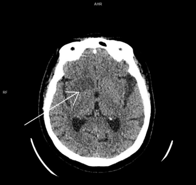 МСКТ головного мозга без контрастного усиления в аксиальной проекции пациентки Н. при поступлении