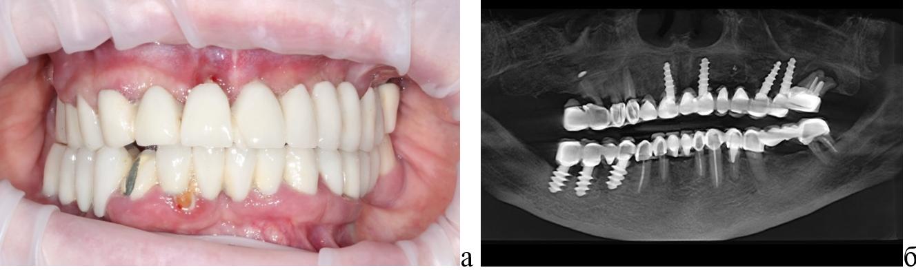 Вид старой металлокерамической конструкции с опорой на монотельные имплантаты и зубы верхней челюсти: а – старая ортопедическая конструкция; б – рентгенографическая оценка состояния опорных зубов