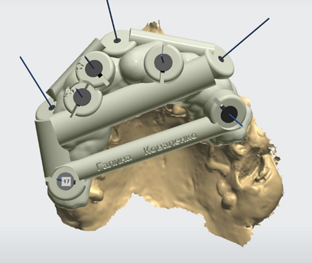 Цифровой образ навигационного шаблона для остеотомии с фиксирующими пинами