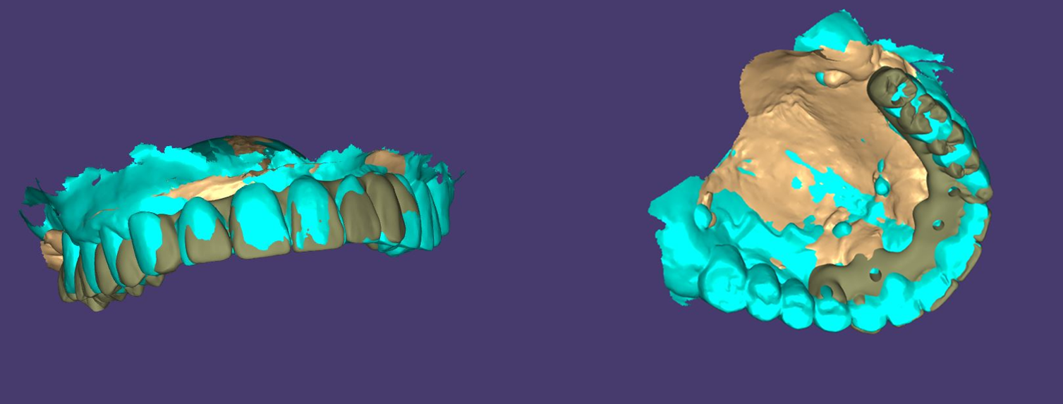 Совмещение образа старого протеза с новой шинирующей конструкцией временного протеза в программе EXOCAD