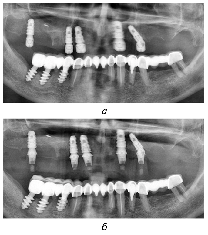 Рентгенографический контроль: а - спустя 3 месяца после установки имплантатов; б - спустя 6 месяцев после установки имплантатов