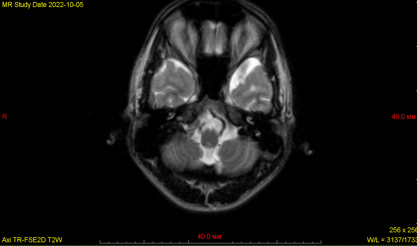 Аксиальная МР – томограмма головного мозга курсанта первого курса М. в режиме Т2-ВИ на уроне мостомозжечковых углов