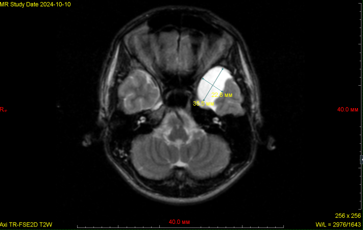 Аксиальная МР – томограмма головного мозга отчисленного на первом курсе курсанта М. в режиме Т2-ВИ на уроне мостомозжечковых углов