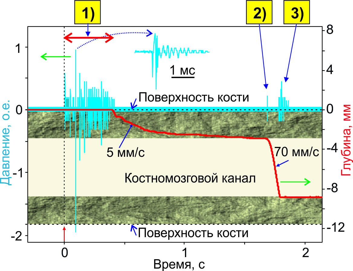 Схема иллюстрирующая связь зарегистрированных акустических сигналов с положением торца оптоволокна в различные моменты времени при лазерной перфорации кости: 1-3 - три характерных случая генерации акустических сигналов