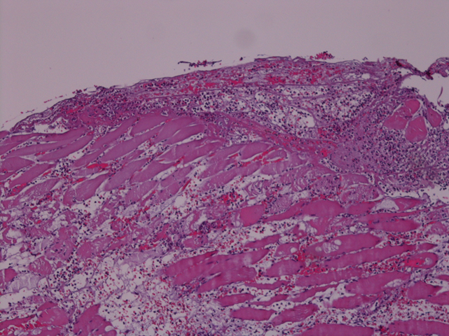 Срез скелетной мышцы (фрагмент musculus Digastricus (venter anterior), взятой интраоперационно у пациента основной группы) с участками некроза, диффузной инфильтрацией полиморфноядерными лейкоцитами неравномерной плотности