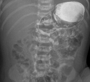 Ребенок возрастом 5 дней, пассаж контрастного препарата