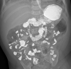 Ребенок возрастом 2 месяца 10 дней, пассаж контрастного препарата