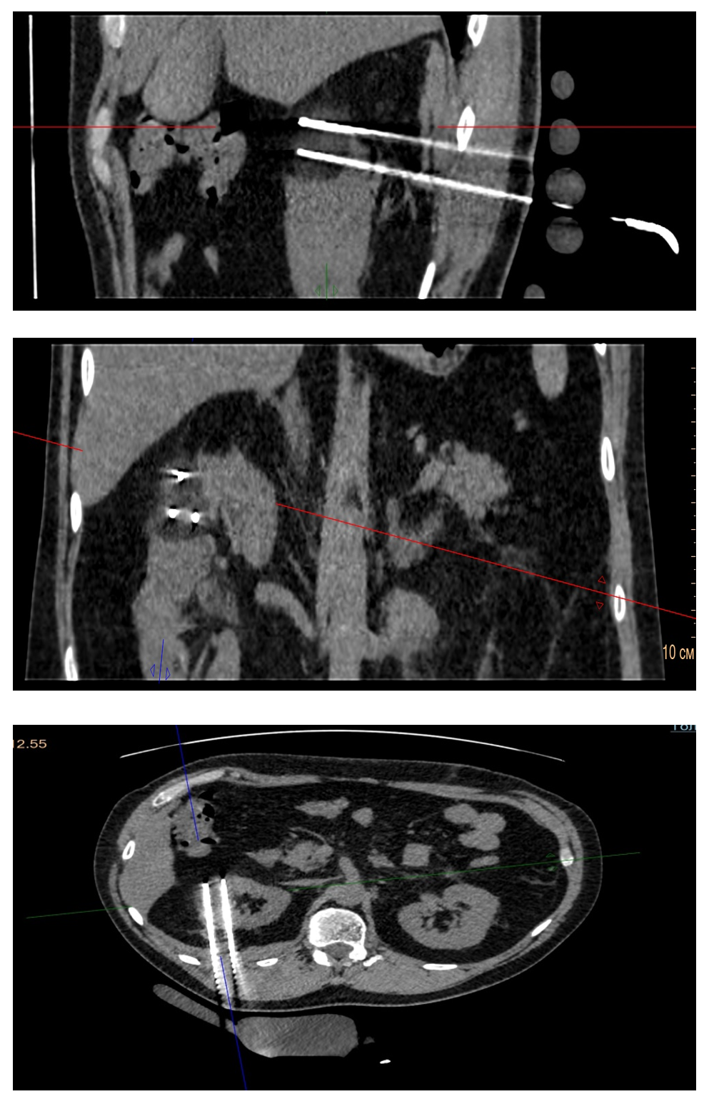 Послеоперационный период