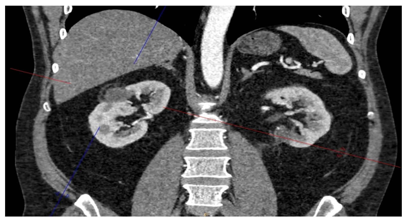 Через 3 месяца после последнего вмешательства