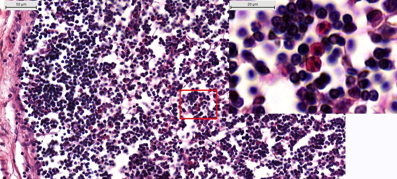 Эозинофилия коркового вещества лимфатического узла (контрольная серия)