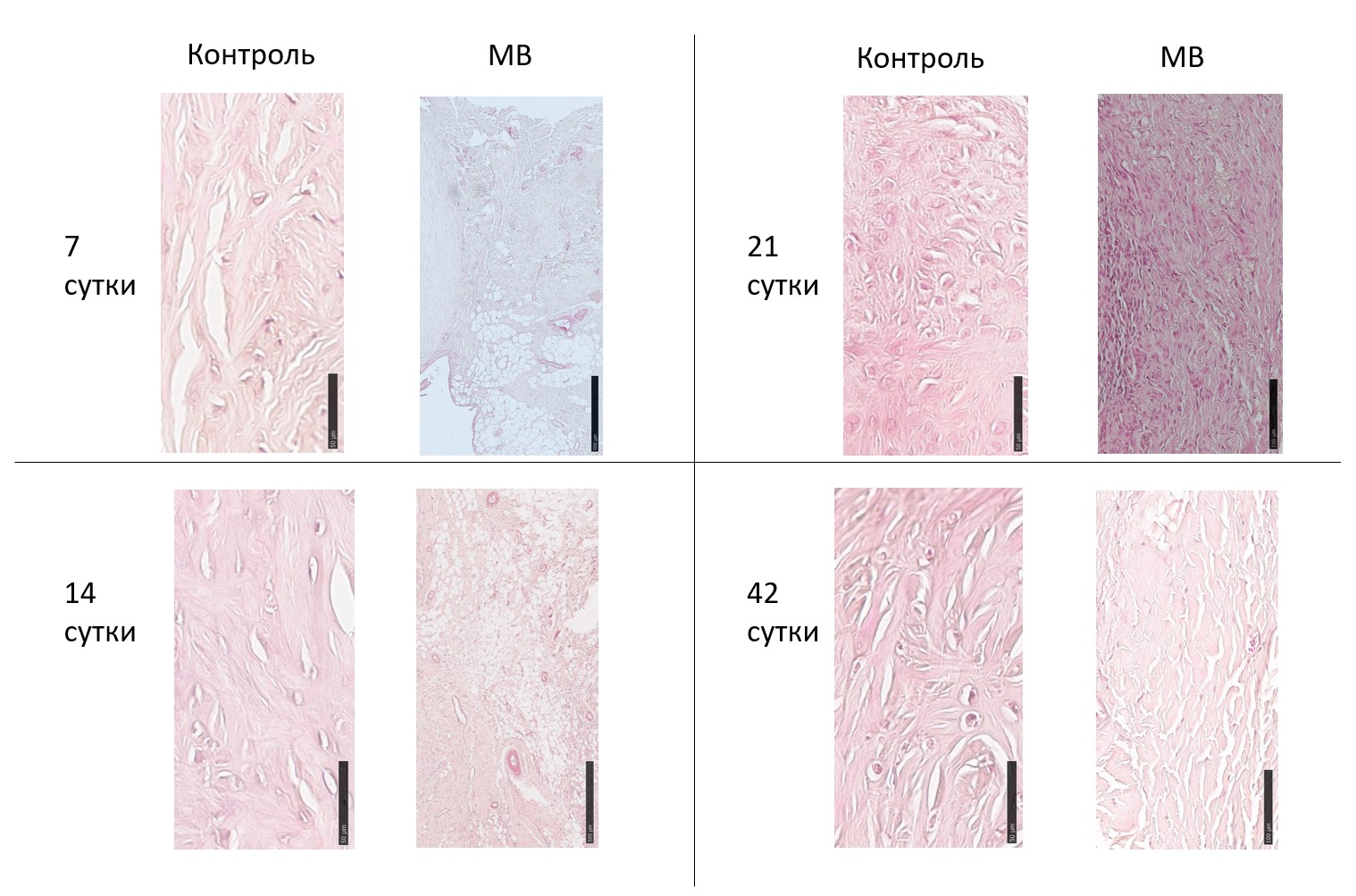 Срез мениска в зоне повреждения