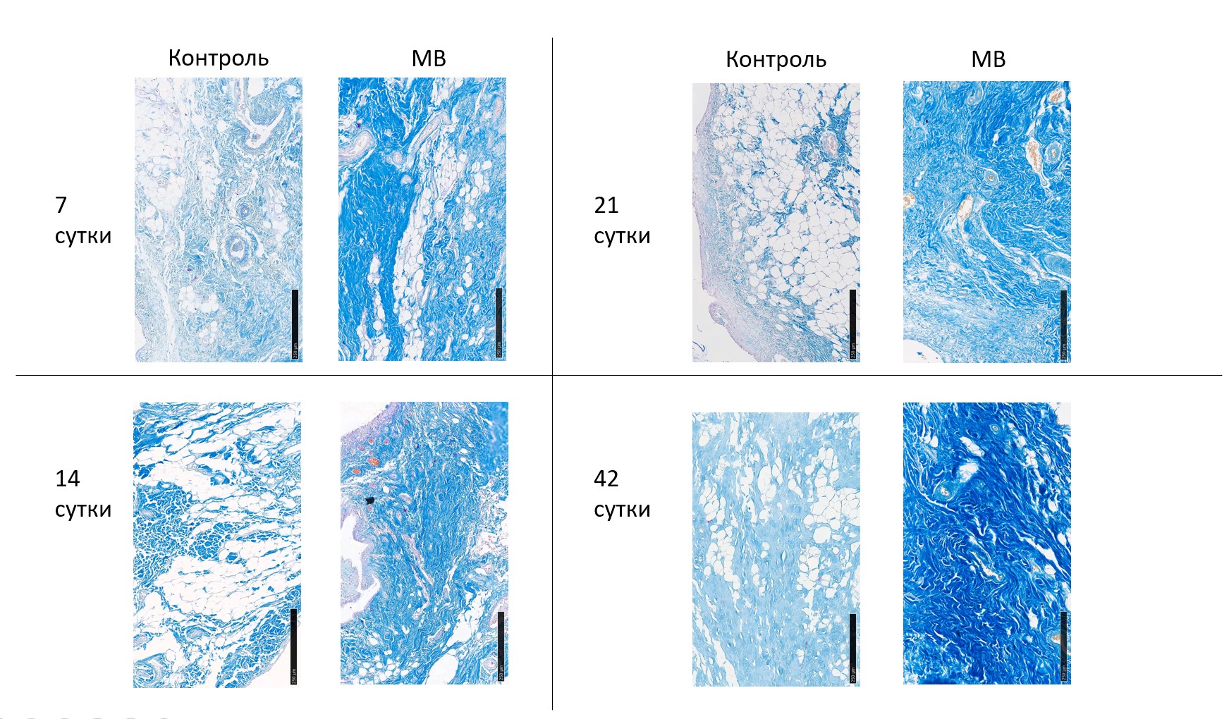 Срез мениска в зоне повреждения