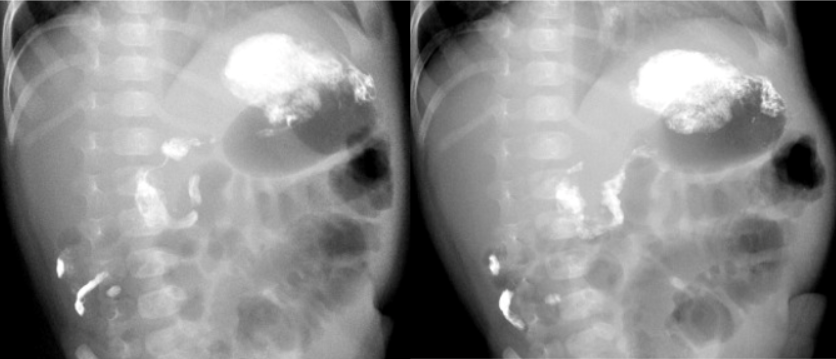 Ребенок возрастом 2 месяца 10 дней, пассаж контрастного препарата