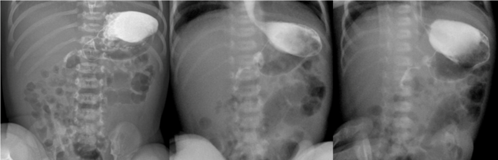 Ребенок возрастом 5 дней, пассаж контрастного препарата