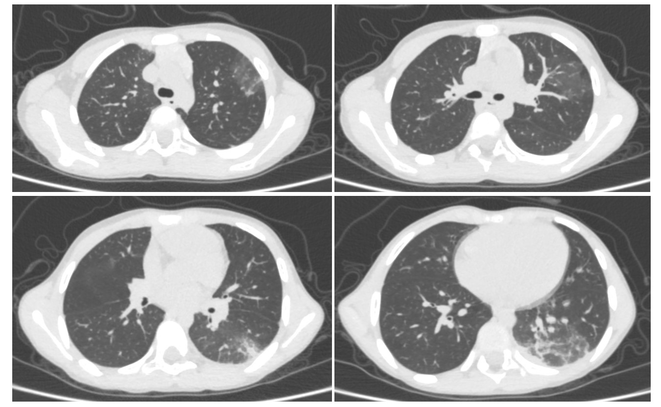 КТ-картина соответствует левосторонней полисегментарной инфильтрации с положительной динамикой в сравнении с предыдущим исследованием