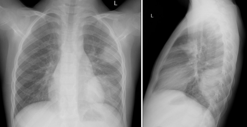 На рентгенограмме органов грудной клетки определяются полисегментарные инфильтративные изменения в левом легком