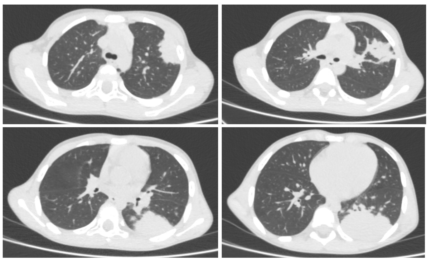 КТ-картина соответствует левосторонней полисегментарной пневмонии
