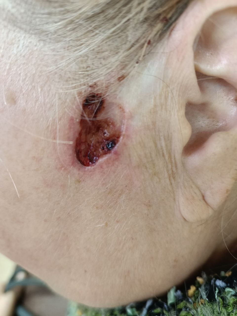 Пациентка С. Язвенная форма базальноклеточного рака кожи лица в левой височной области