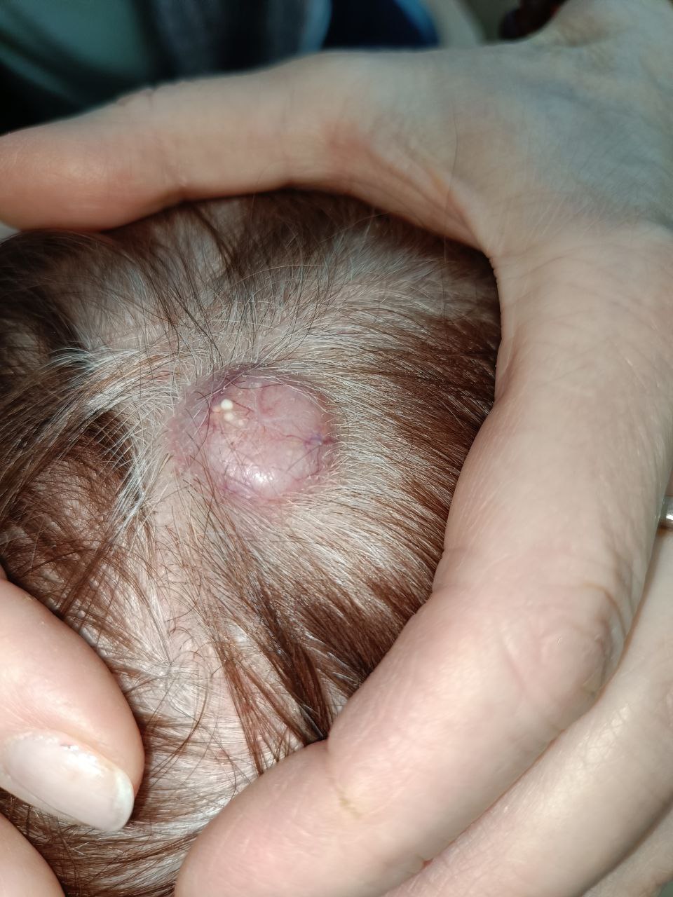 Пациентка Г. Узловая форма базальноклеточного рака кожи волосистой части головы в теменной области