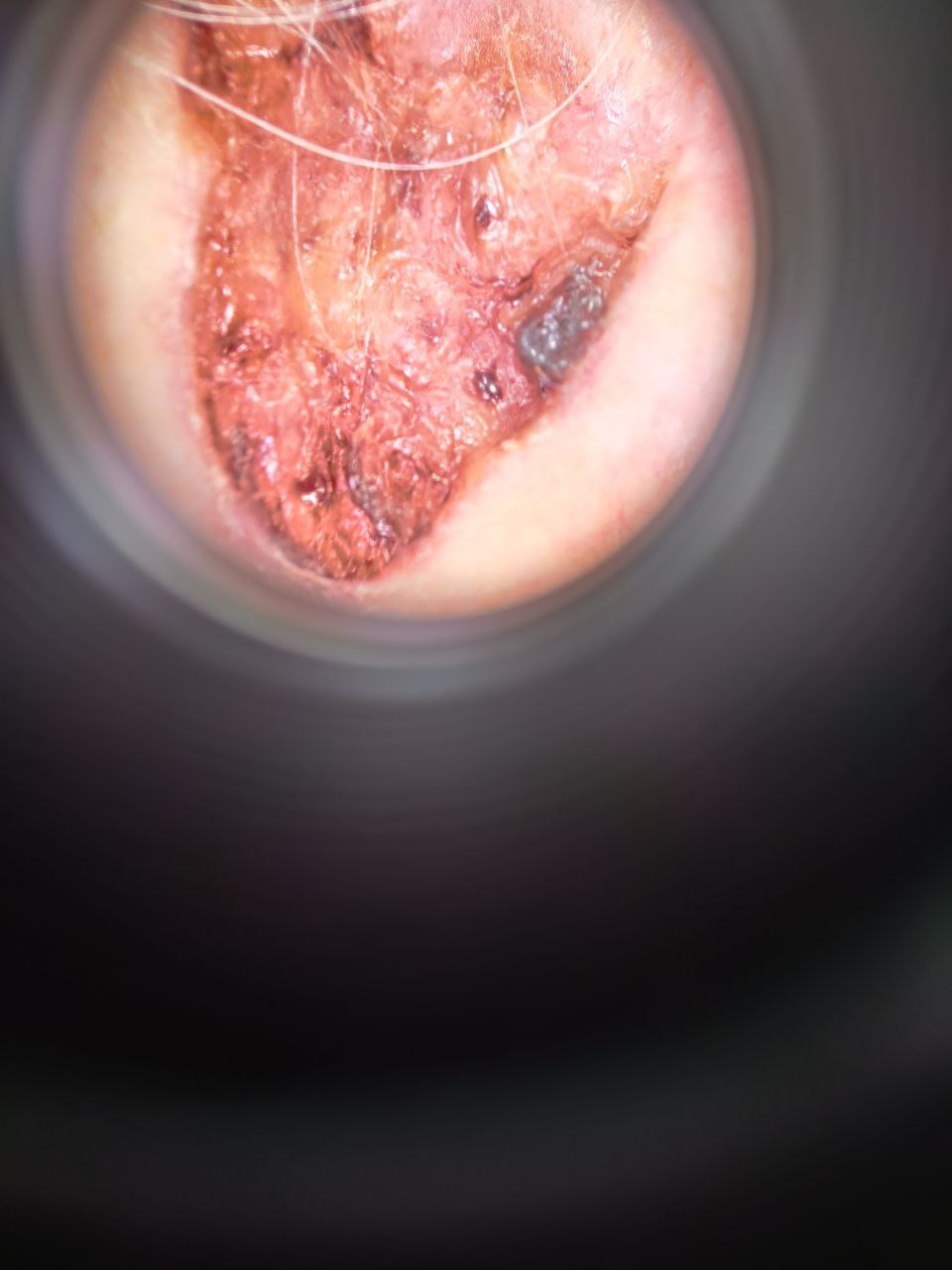 Пациентка С. Дерматоскопическая картина язвенной формы базальноклеточного рака кожи лица в левой височной области