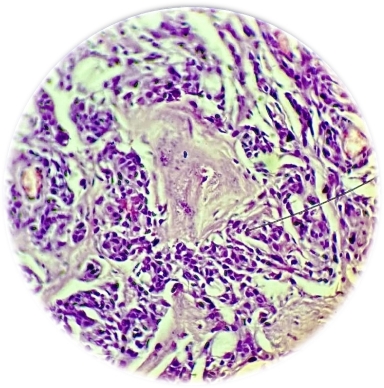 Солидные и трабекулярные структуры медуллярной карциномы щитовидной железы