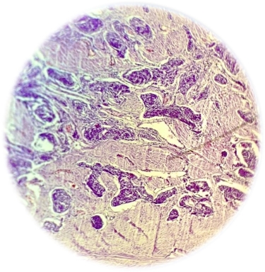 Медуллярная карцинома щитовидной железы. Общий вид