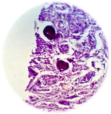 Медуллярная карцинома щитовидной железы. Очаги обызвествления