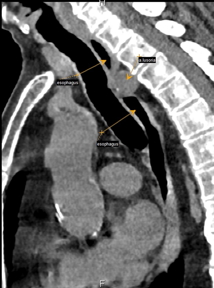 Пациент А. 1955 г.р., сагиттальная проекция КТ органов грудной клетки