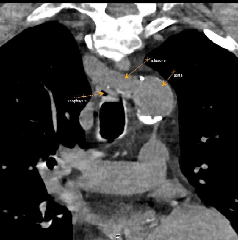  Пациент А. 1955 г.р., корональная проекция КТ органов грудной клетки