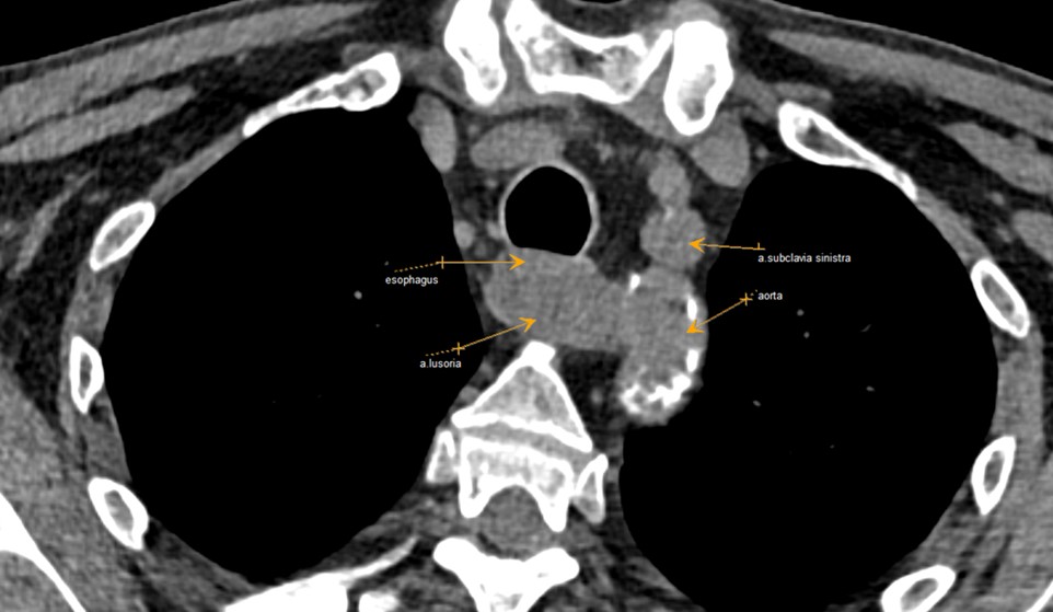 Пациент А. 1955 г.р., аксиальная проекция КТ органов грудной клетки