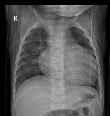 Рентгенография органов грудной клетки на момент госпитализации в ГБУЗ СК КДКБ г. Ставрополь