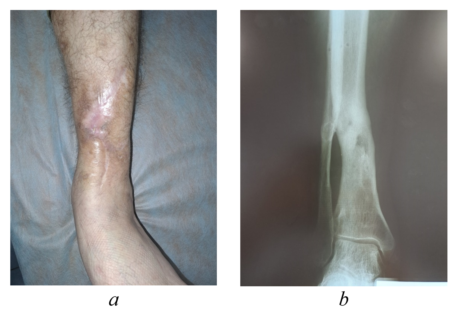 Clinical appearance (a) and radiographic imaging (b) of the left shin in patient Yu., 43 years old, at 13-month postoperative follow-up