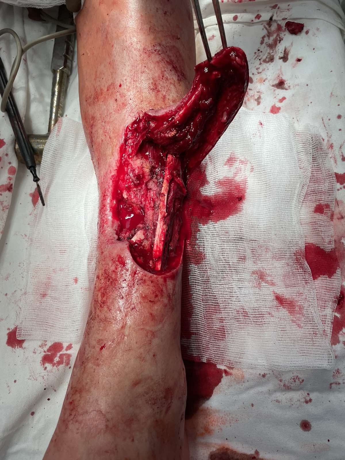 Surgical stage - formation of a pedicled skin-subcutaneous-fascial flap for wound closure