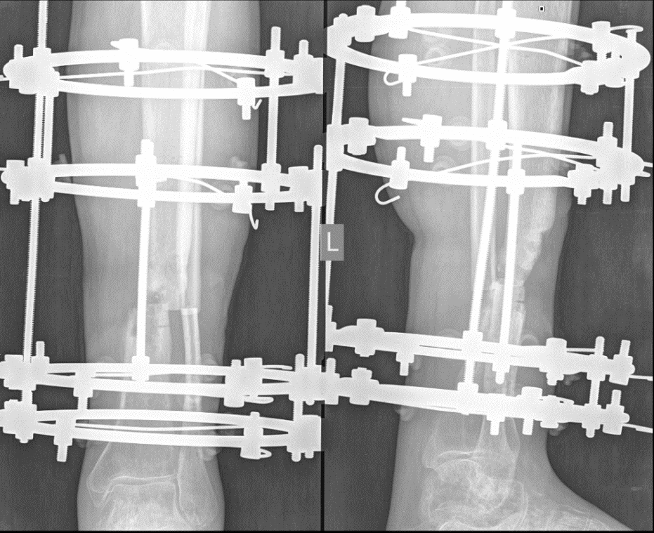 Intraoperative radiograph of the left shin of patient Yu., 43 years old
