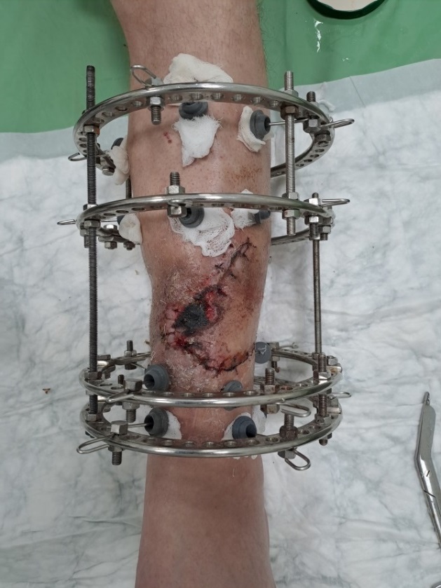 Postoperative appearance of the left shin in patient Yu., 43 years old, on day 7 after surgery