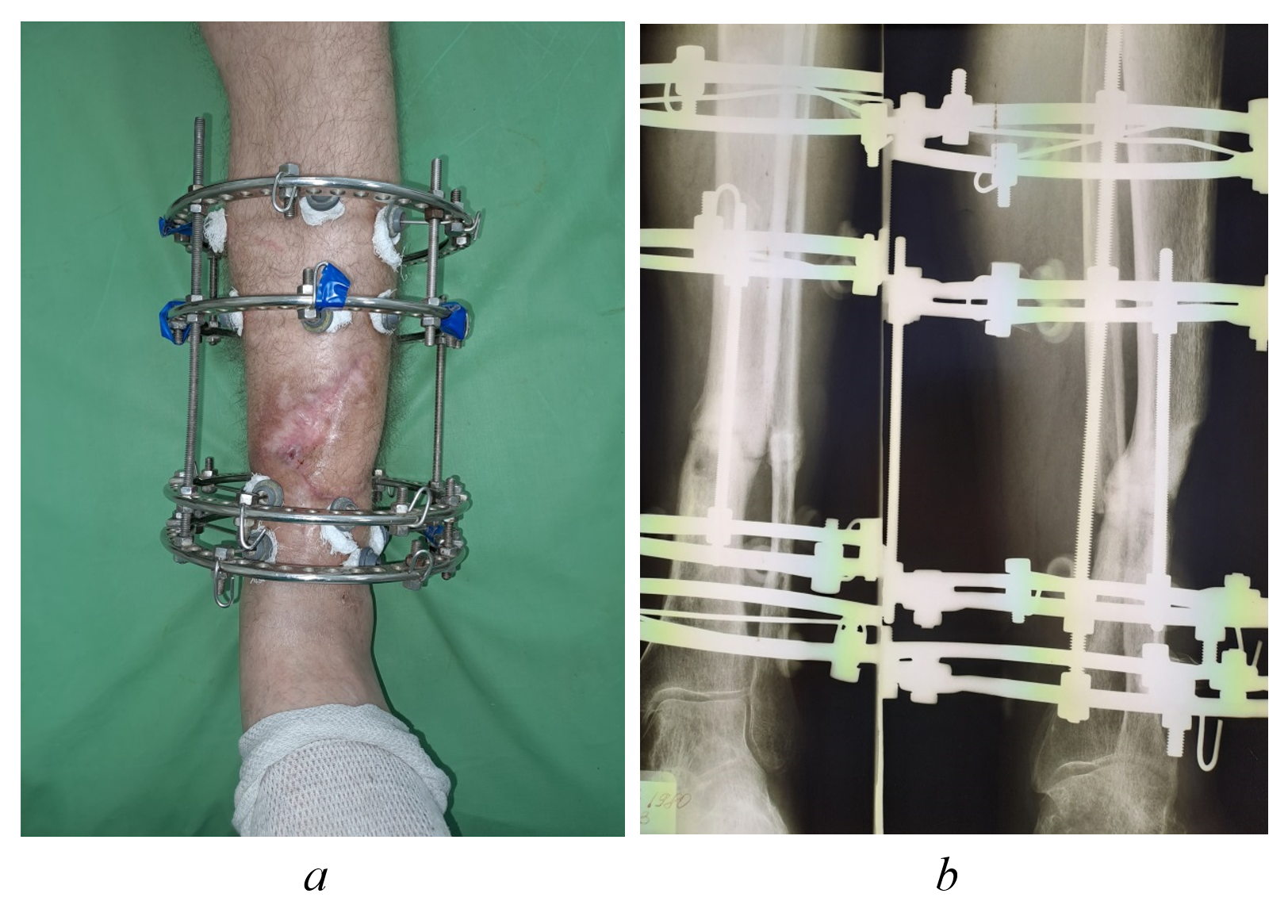 Clinical appearance (a) and radiographic image (b) of the left shin in patient Yu., 43 years old, at 5-month postoperative follow-up