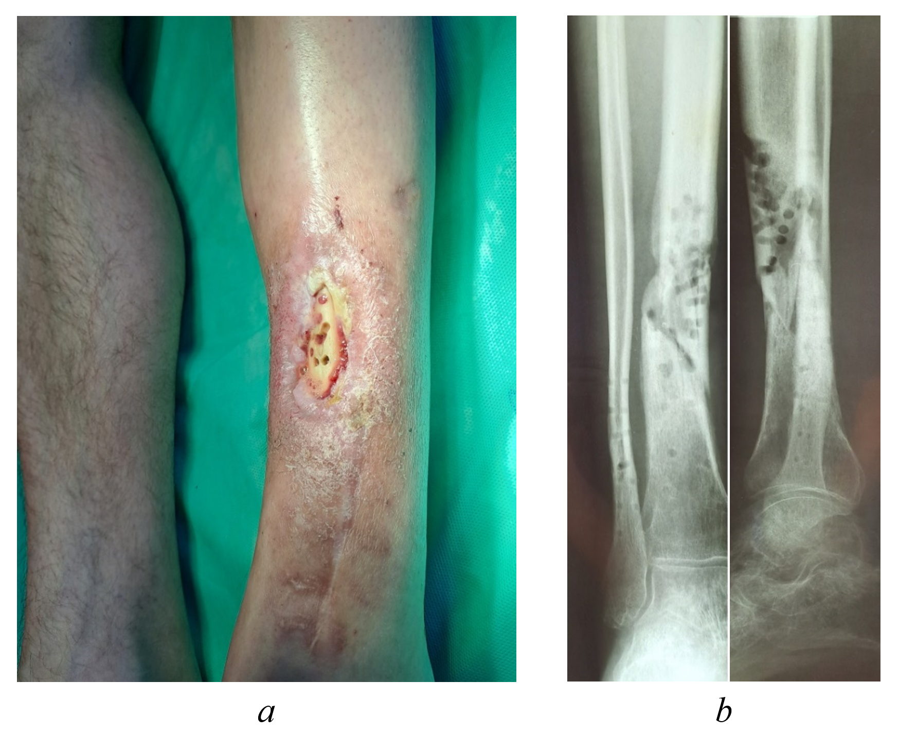External appearance (a) and radiograph (b) of the left shin of patient Yu., 43 years old, upon admission to the Clinics of SamSMU