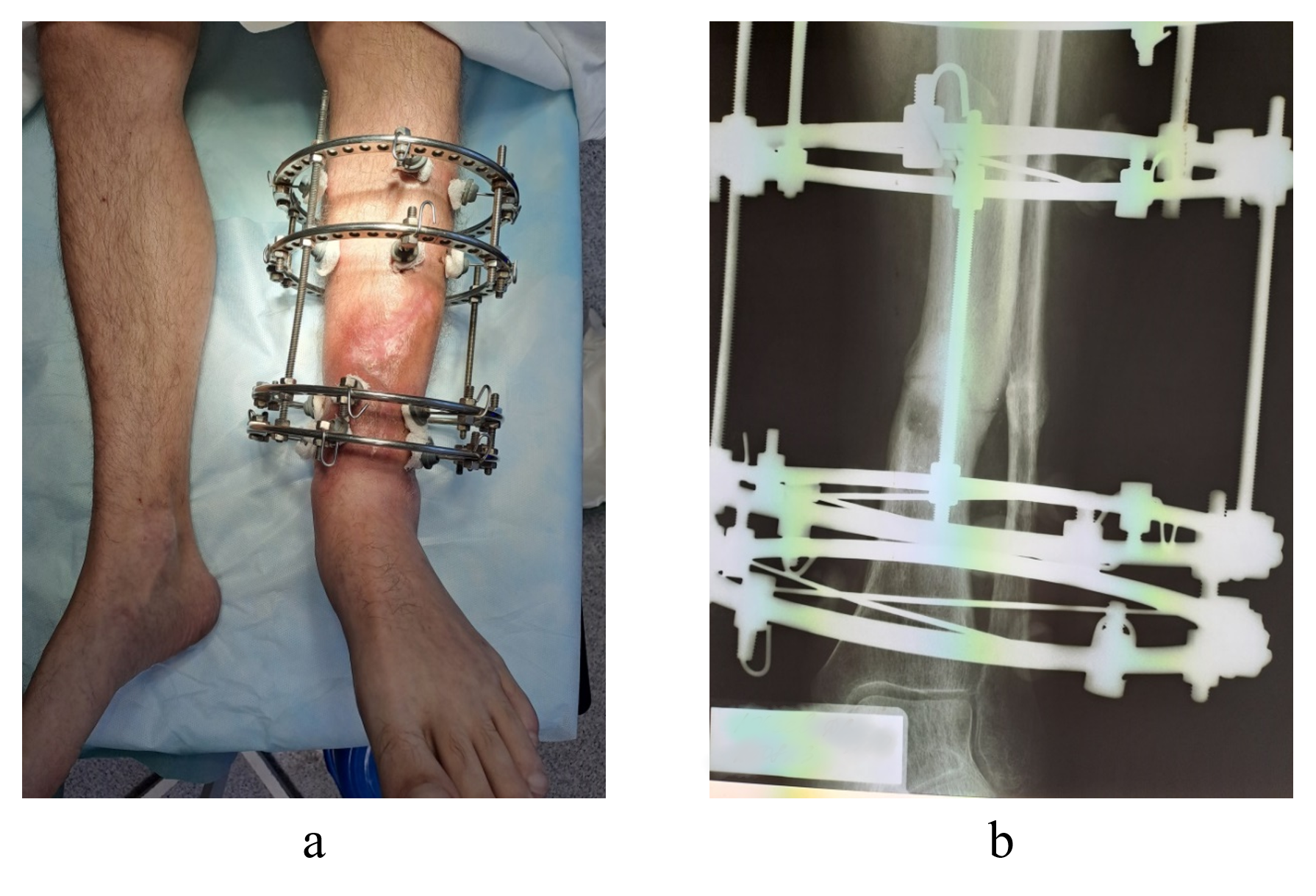 Clinical appearance (a) and radiographic findings (b) of the left shin in patient Yu., 43 years old, at 7-month postoperative follow-up