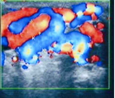 Доплеровское исследование: контрольная группа