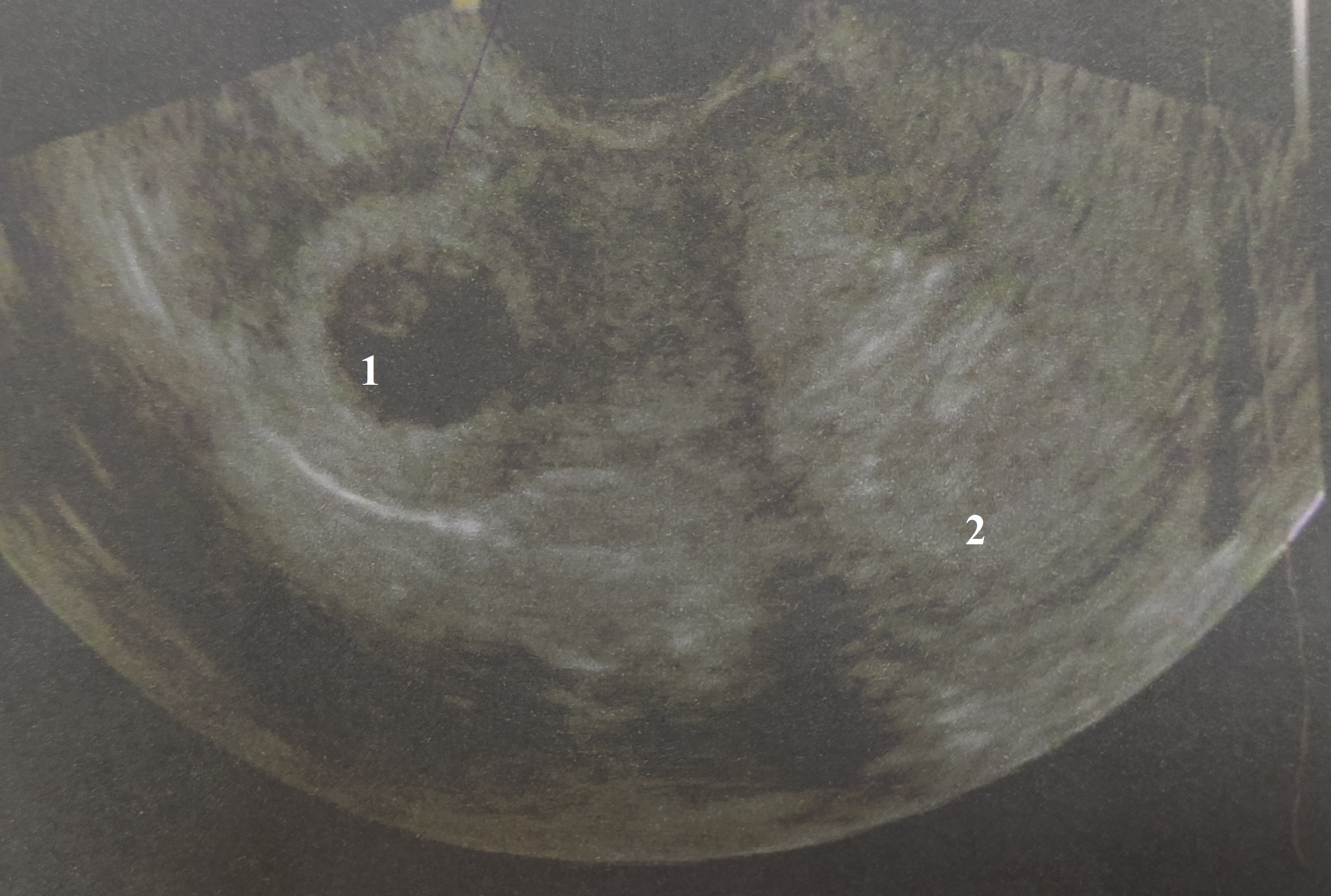 Ультразвуковая сканограмма матки: 1 - полость рога; 2 - полость матки