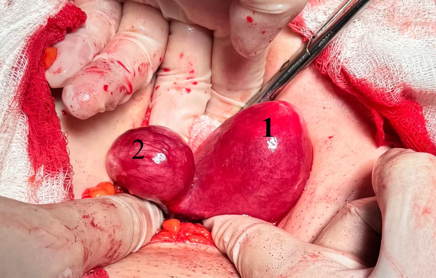 Вид матки на операции: 1 - тело матки; 2 - рудиментарный рог с плодным яйцом