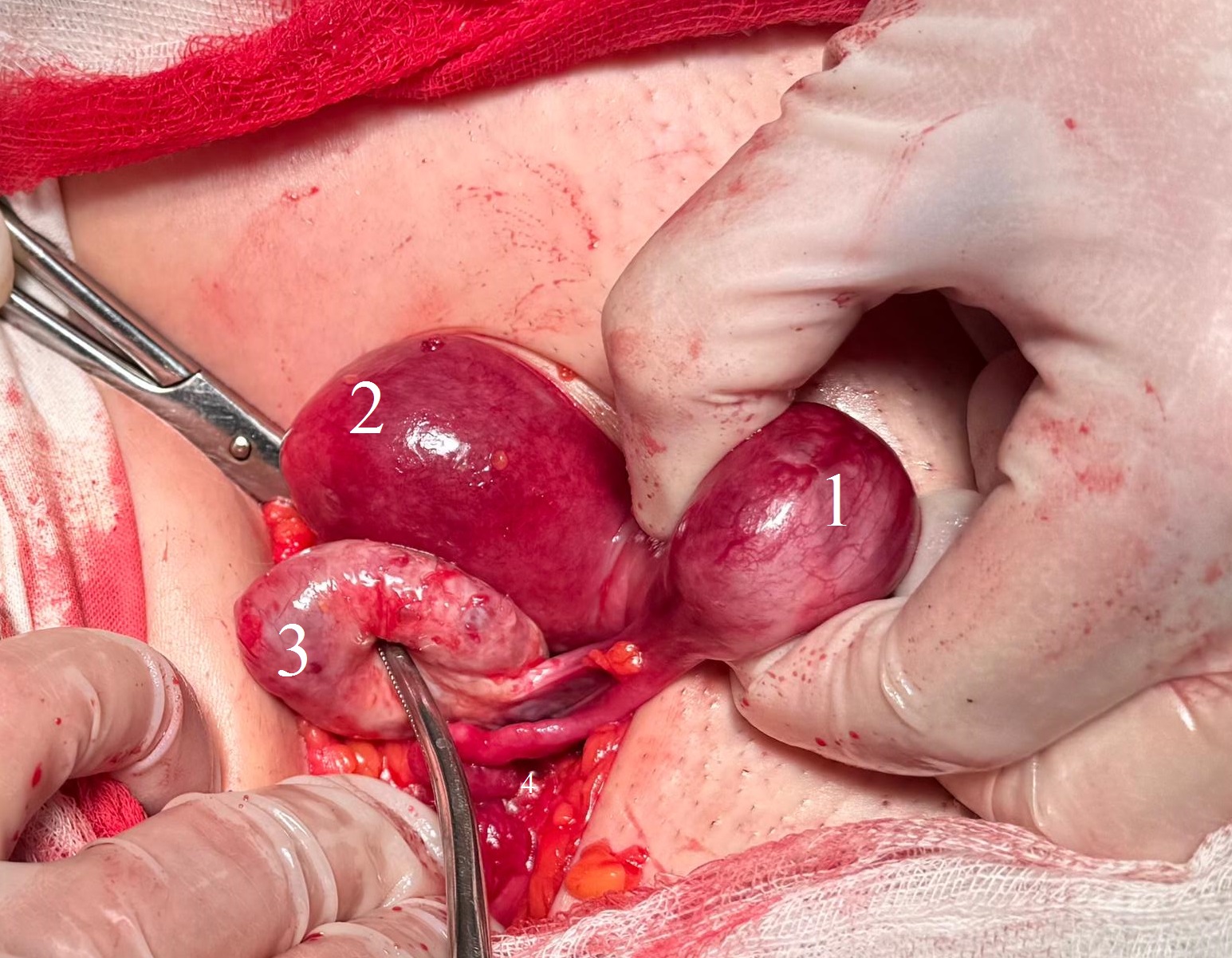 Интраоперационно: 1 - рудиментарный рог; 2 - тело матки; 3 - правый яичник