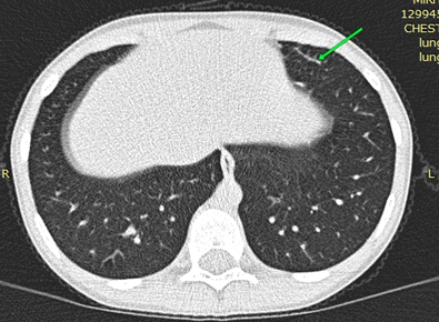 MCКТ органов грудной клетки у ребенка Д