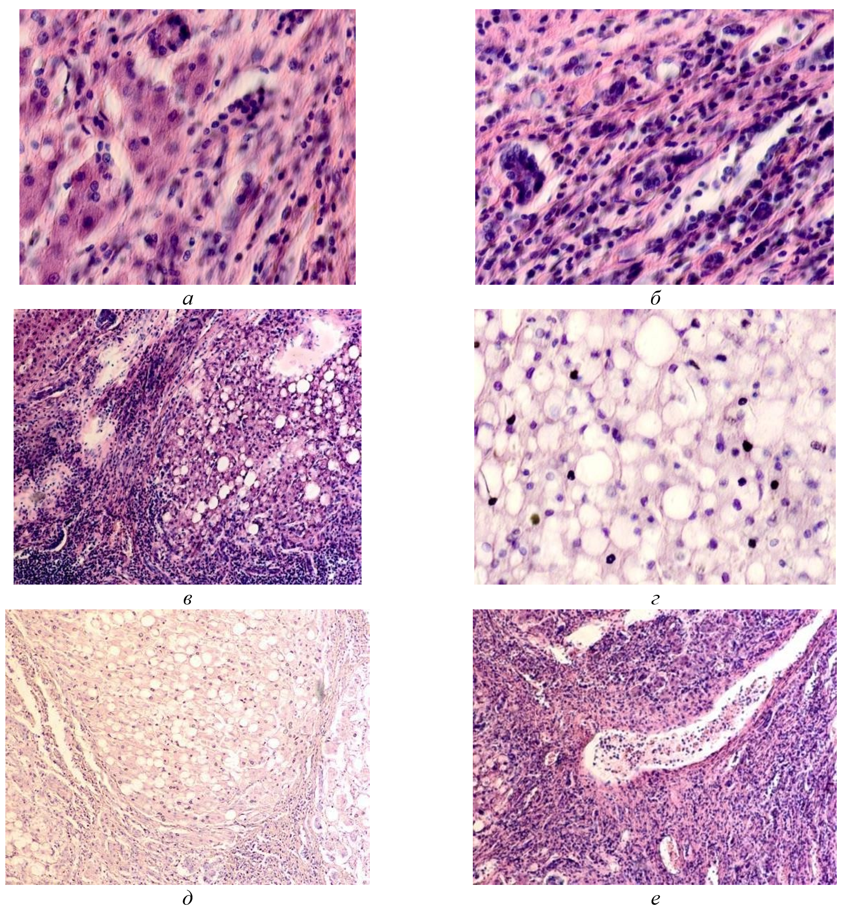 Паренхимная структура печени больных с гепатитом С у ВИЧ инфицированных пациентов, псевдодолька печени: а, б - лейкоцитарная диффузия междольковых структур; в, г -  жировой гепатоз; д, е - цирроз