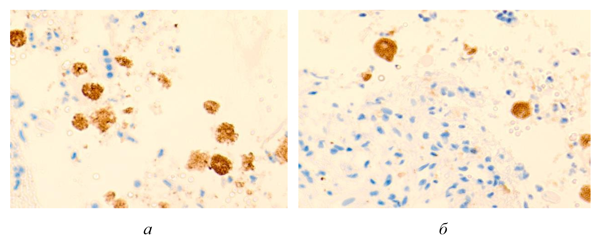 Макрофагальные клетки с трансферрином внутри проема кровеносных сосудов печени больного гепатитом С на фоне ВИЧ инфицирования