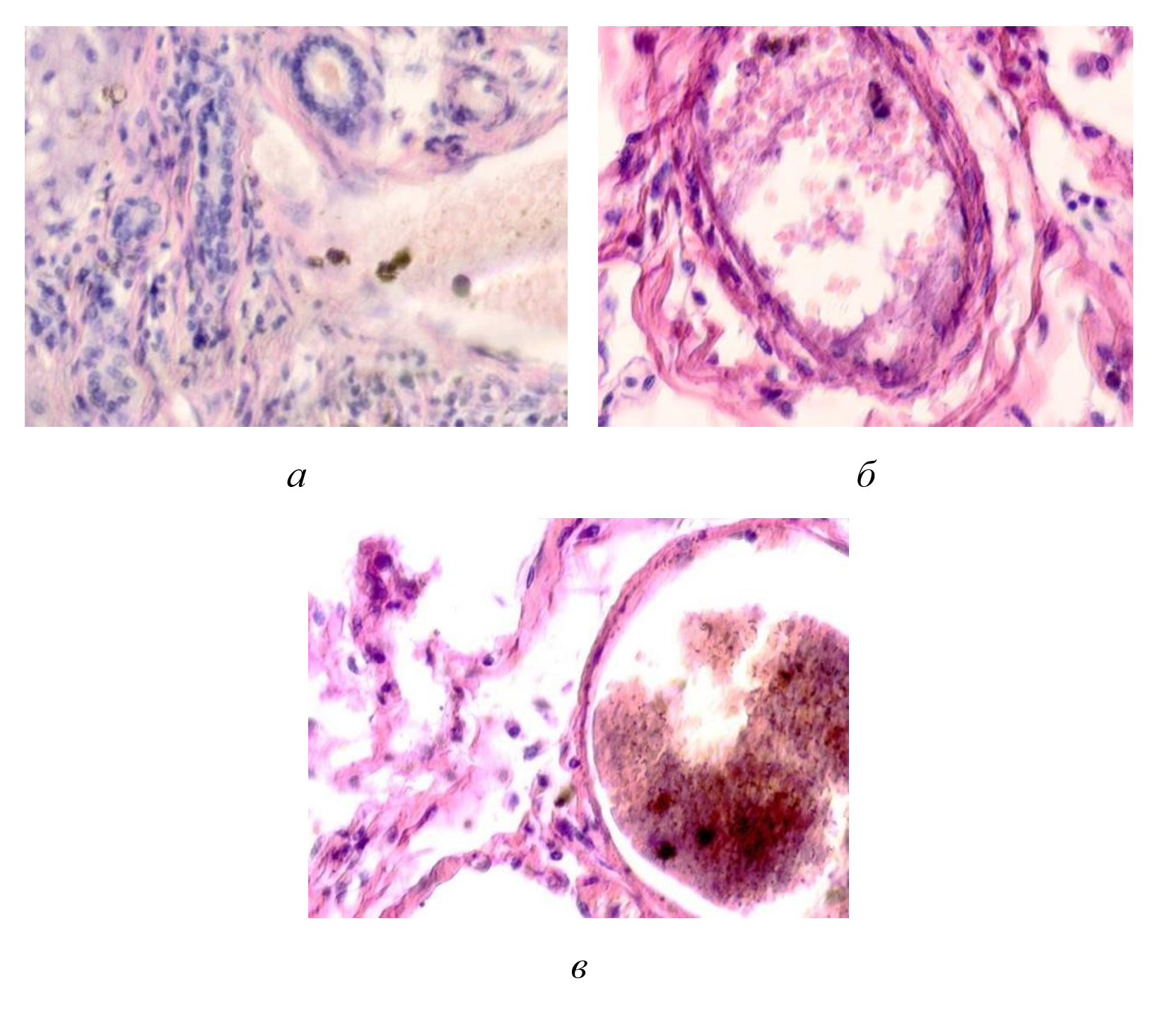 Паренхимные структуры печени человека у ВИЧ инфицированных пациентов: а - макрофагальные клетки с внедрением в цитоплазму пигмента в проеме сосуда; б - пигмент в цитоплазме макрофагальных клеток и диффузно расположенный в проеме сосуда; в - пигмент в проеме сосуда