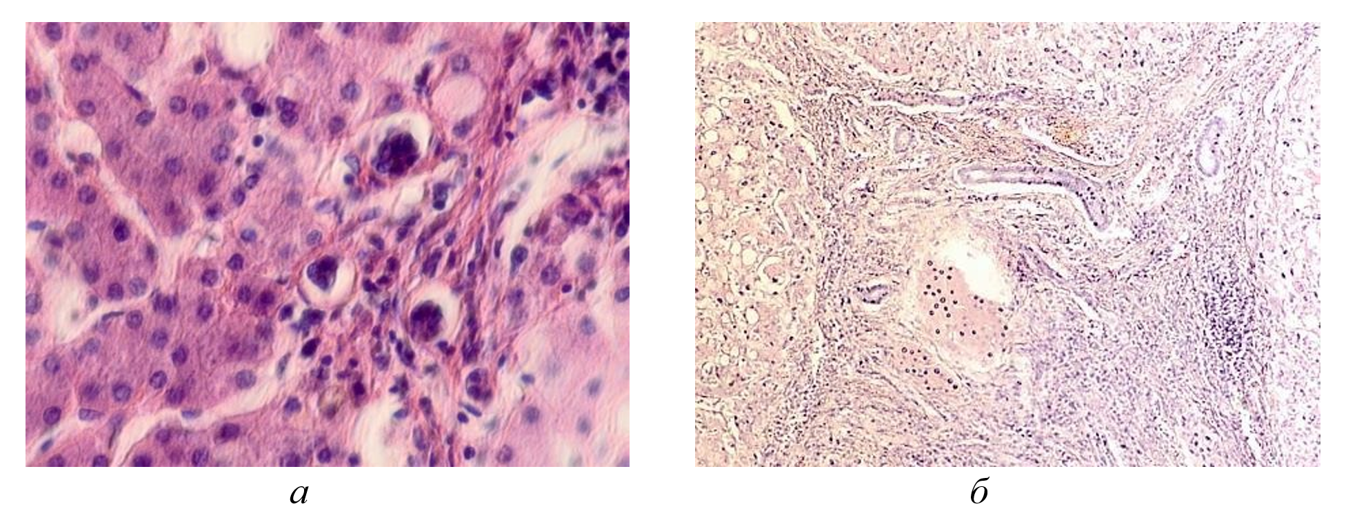 Паренхимная структура печени больных с гепатитом С у ВИЧ инфицированных пациентов, псевдодолька печени: а - тельца Councilman; б - замещение клеток паренхимы печени рубцовой тканью и клеточный некроз, отсутствует центральная вена, апоптоз гепатоцитов