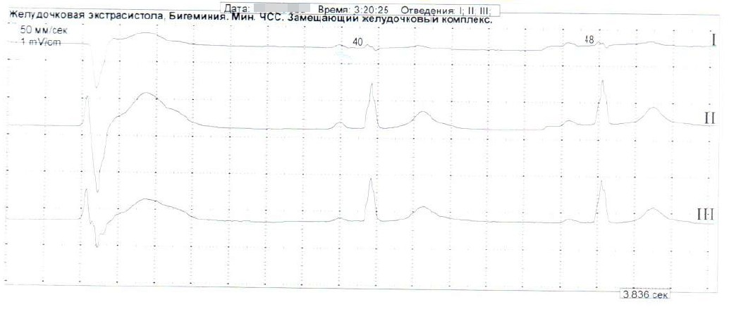 Фрагмент суточного мониторирования ЭКГ по Холтеру